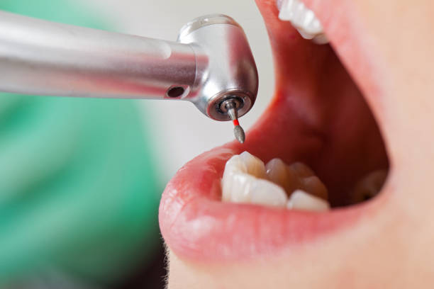 Best Emergency Dental Care for Broken or Chipped Teeth in Penhook, VA